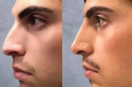 هر آنچه پیش از تزریق فیلر بینی باید بدانید