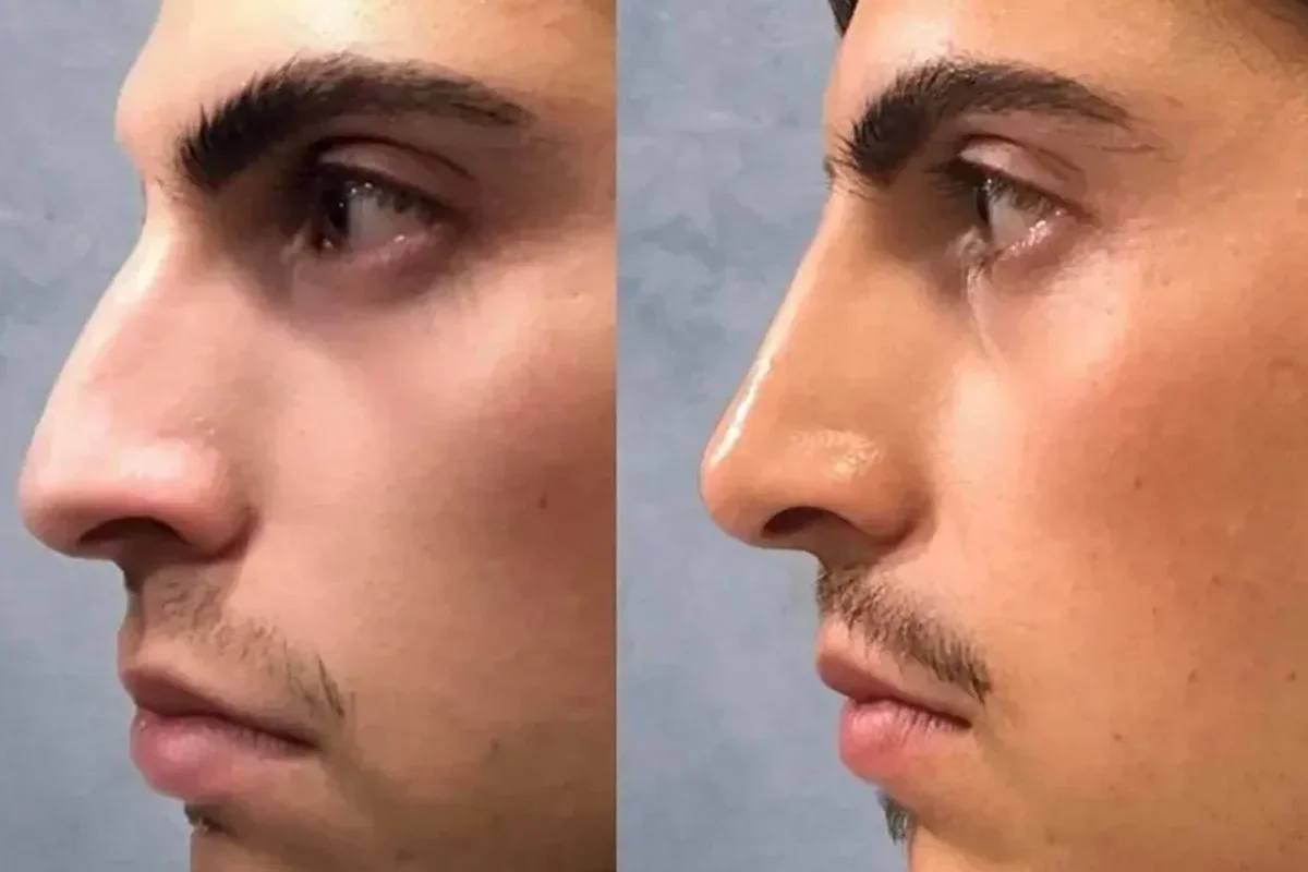 هر آنچه پیش از تزریق فیلر بینی باید بدانید
